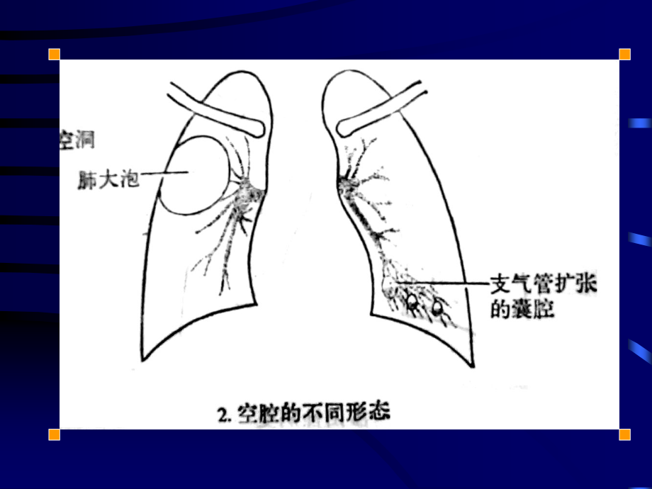 胸部病变的基本影像学表现教学课件（下）_第3页