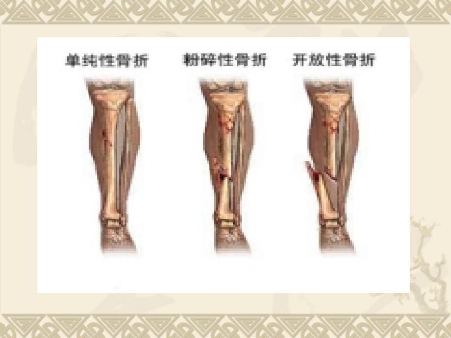 临床医学胫腓骨骨折护理课件_第5页