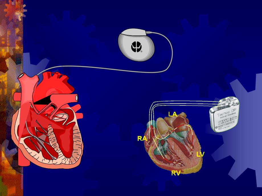 人工心脏起搏器课件_第4页