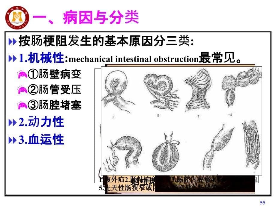 肠疾病病理远离介绍_第5页