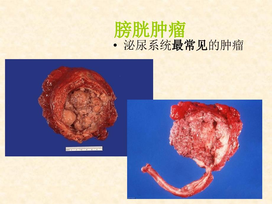 教学查房膀胱肿瘤课件_第4页