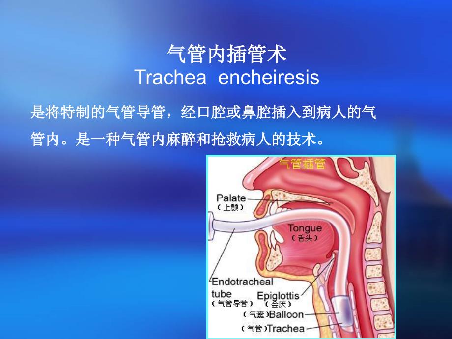 气管插管小发明 ppt课件_第4页