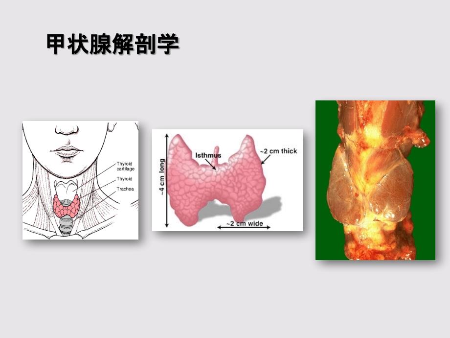 内分泌系统精品教学（南方医学院）甲状腺疾病病理 2017课件_第2页