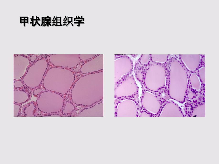 内分泌系统精品教学（南方医学院）甲状腺疾病病理 2017课件_第3页