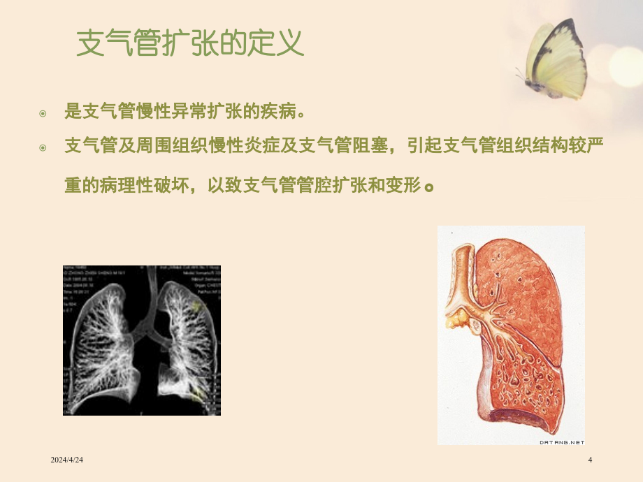 支气管扩张疾病查房_ppt课件_第4页