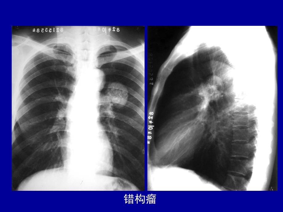 胸部疾病肿瘤课件_第4页