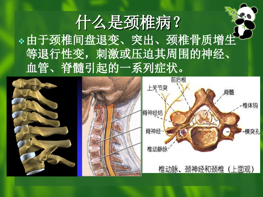 颈椎病的康复课件_2_第3页