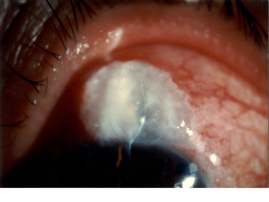 青光眼术后滤过泡形态分级及标准照片课件_第5页