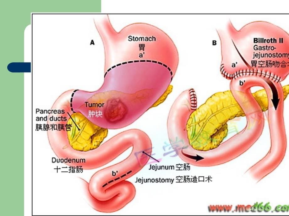 上消化道出血护理查房2015_1课件_第5页