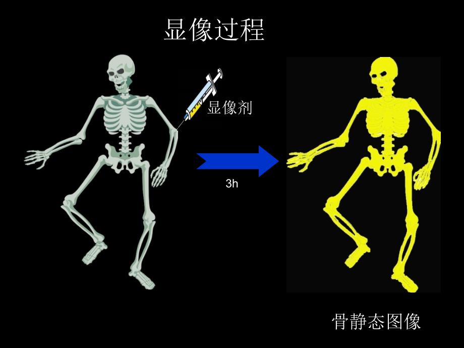 医药学院教学课件 骨显像谭凡_第4页