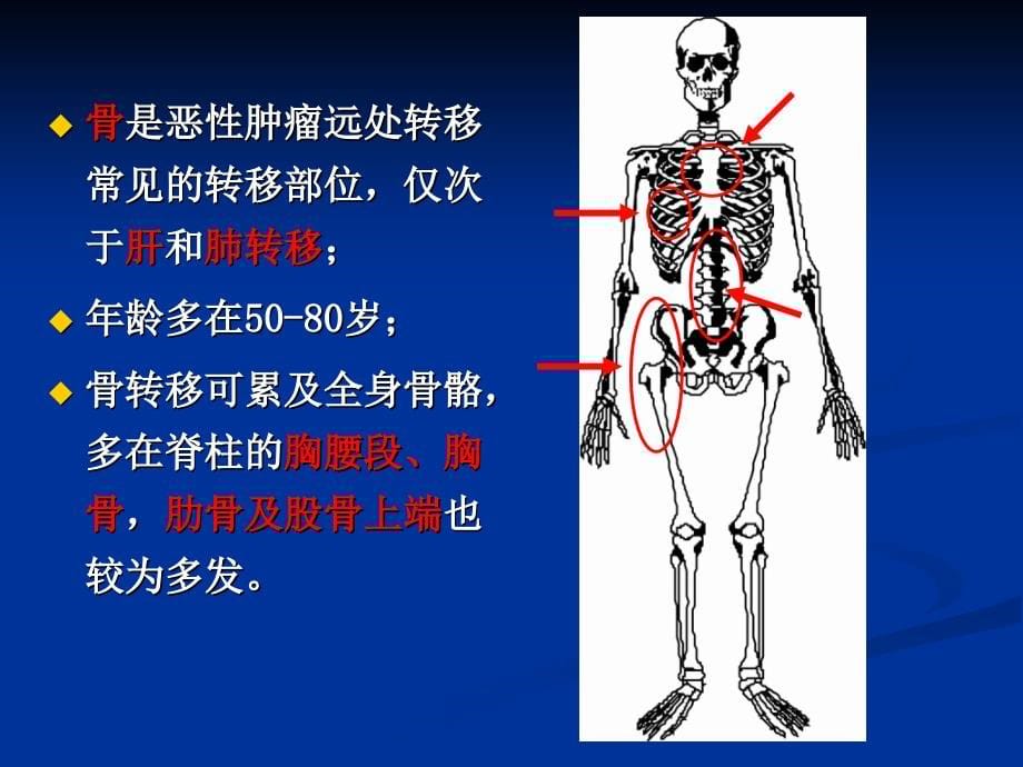 骨转移瘤的治疗课件_第5页