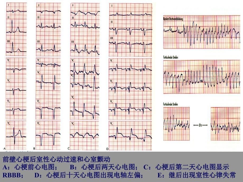 恶性室性心律失常的危险分层与治疗策略课件_第5页