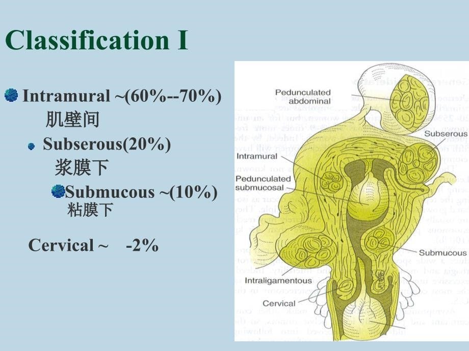 leiomyoma 子宫平滑肌瘤 ppt课件_第5页