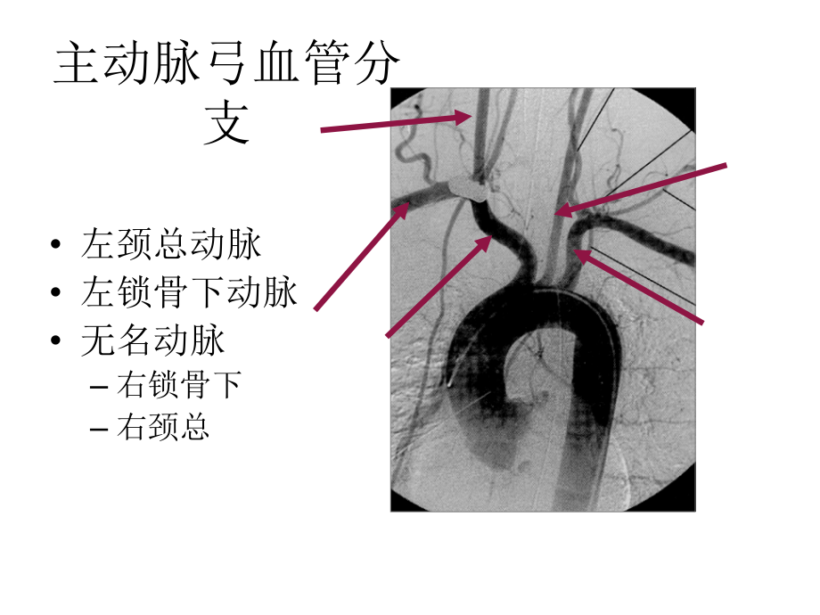 颈部血管超声正常解剖及常见病的超声诊断标准 ppt课件_第4页