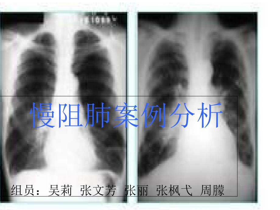 慢阻肺案例ppt课件_第1页