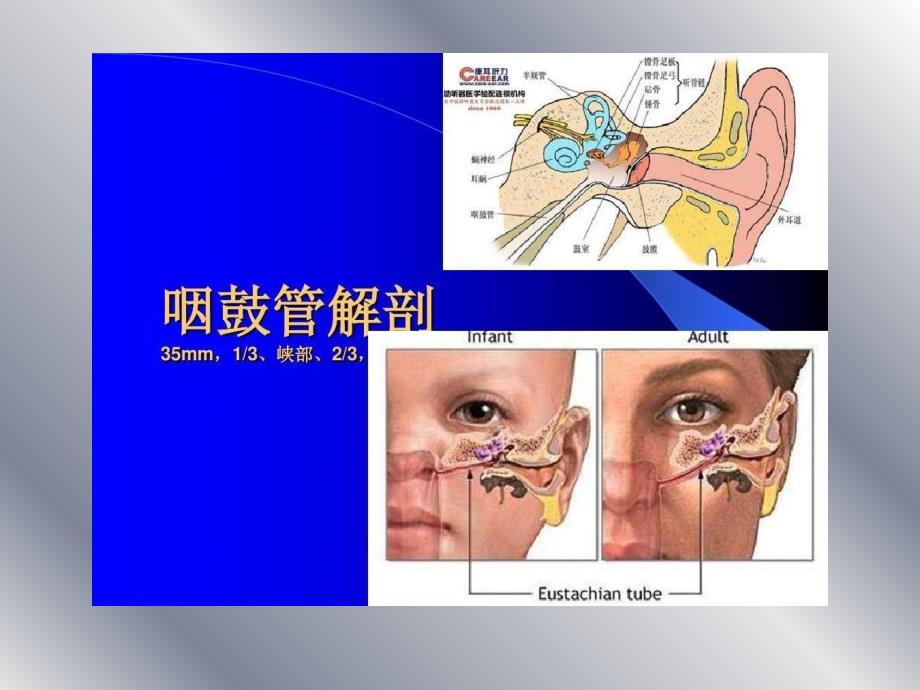 急性化脓性中耳炎_3课件_第3页