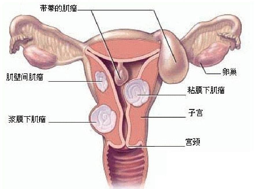 子宫肌瘤病人的护理查房_1课件_第4页