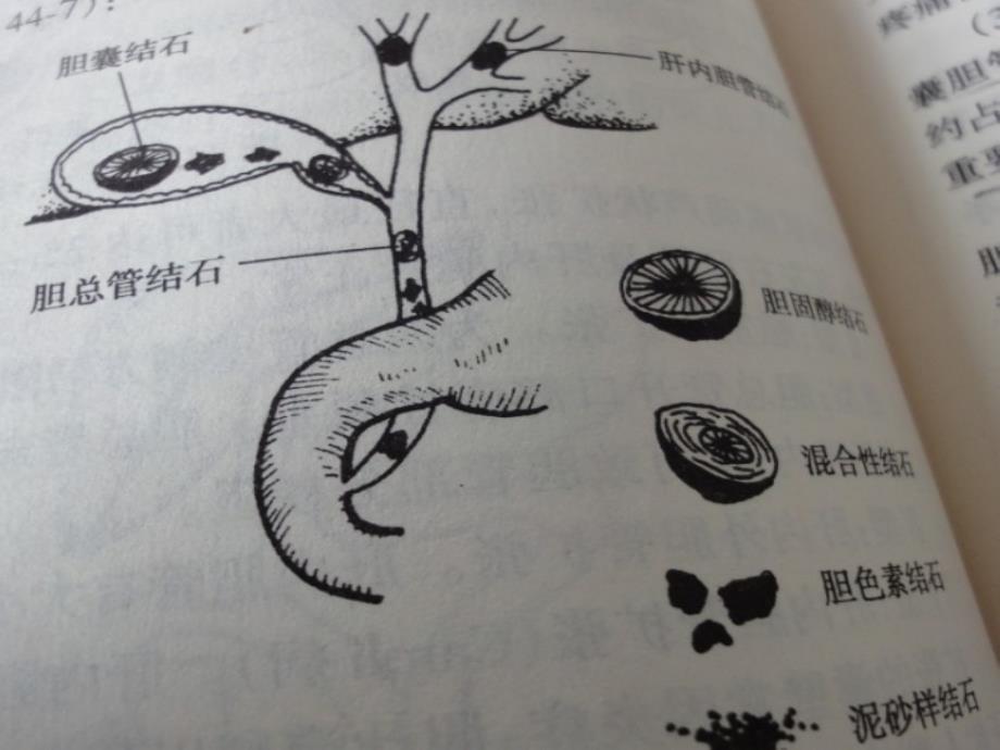 胆石病的诊断与治精品课件_第4页