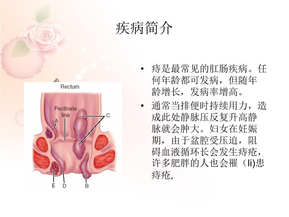 痔疮手术的护理课件_第3页