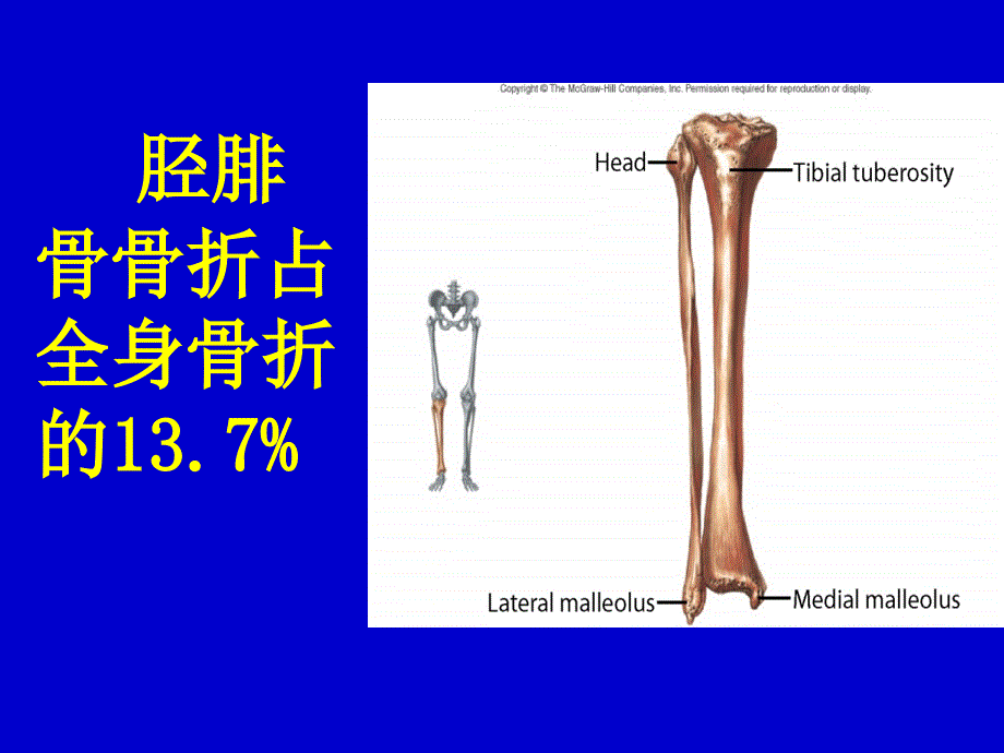 胫腓骨骨折外科学课件_第2页