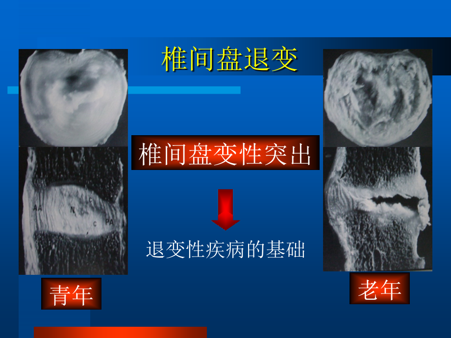 腰椎间盘突出症_21课件_第4页