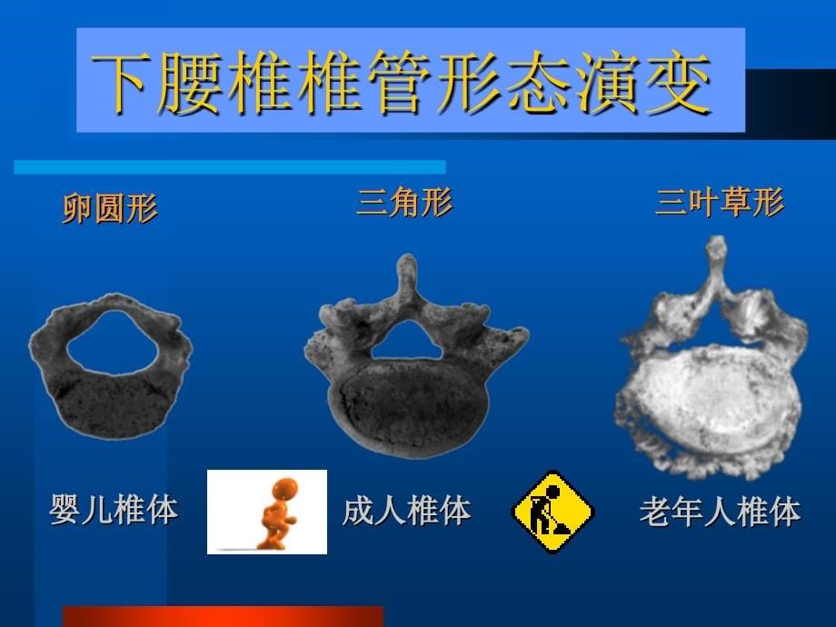 腰椎间盘突出症_21课件_第5页