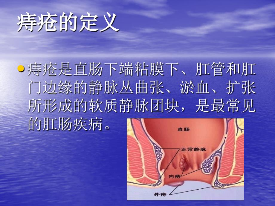 痔疮的预防和护理_2课件_第4页