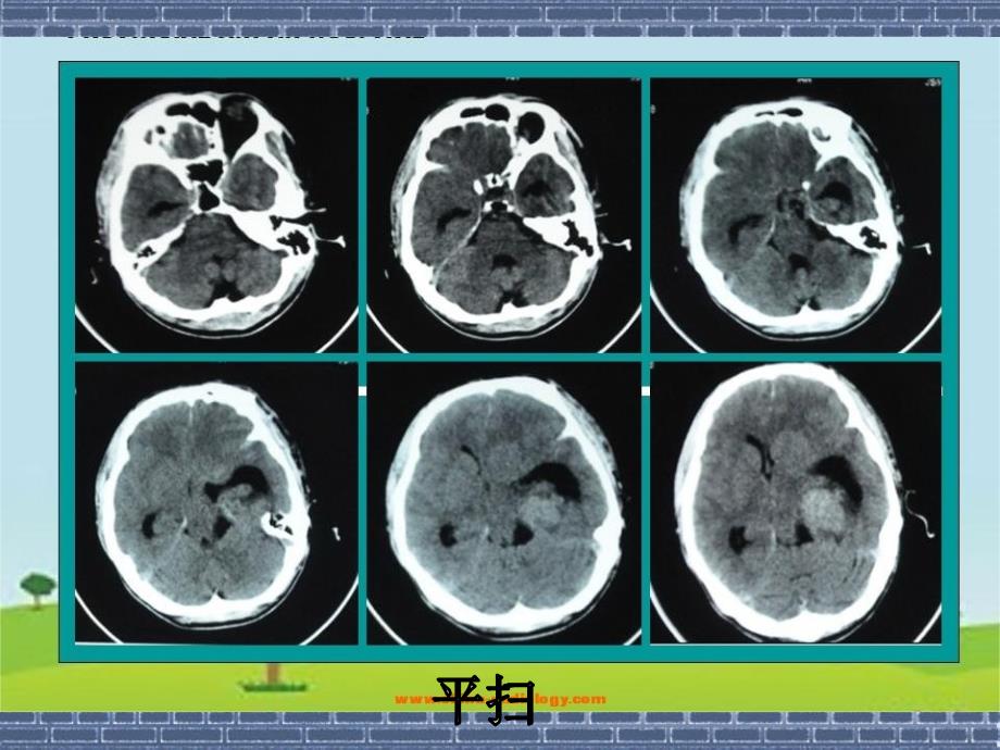 侧脑室脑膜瘤ppt课件_第3页