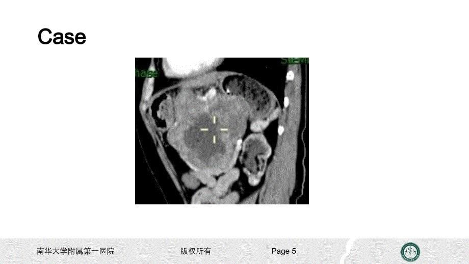 2017读书报告大于cm胃间质瘤与胃良性肿瘤的鉴别ppt课件_第5页