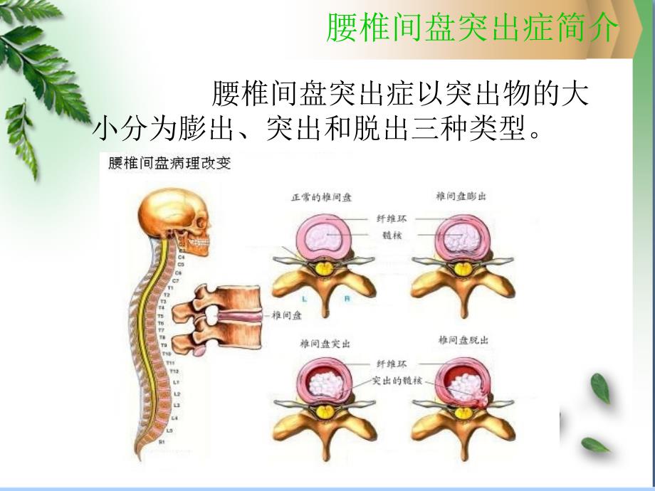 浅谈腰椎间盘突出症的病理及治疗课件_第4页