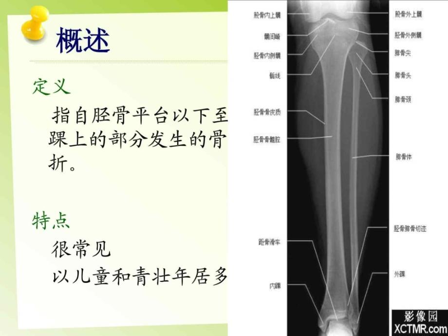 胫腓骨骨折的护理临床医学医药卫生专业资料_1课件_第4页