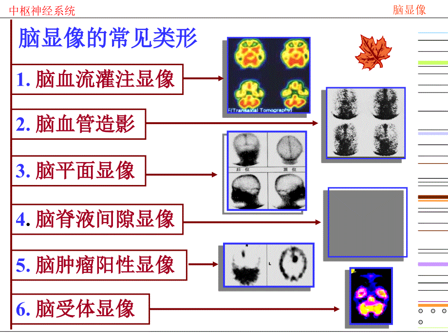 （核医学课件）09脑及脑池显像_第3页