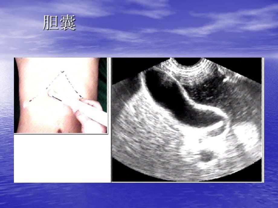 胆系疾病超声诊断课件_第5页