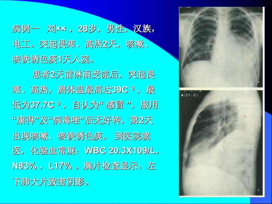 肺部常见综合病征幻灯片_第2页