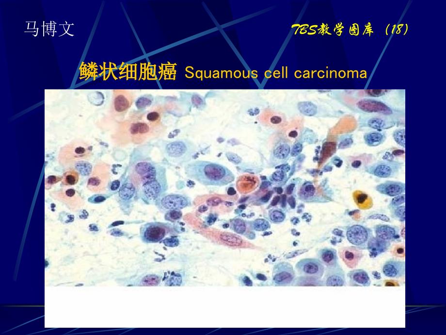 宫颈液基脱落细胞学图库tbs分类1_（13）课件_第1页