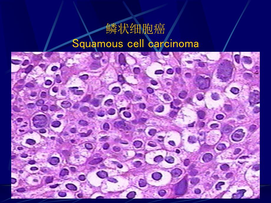 宫颈液基脱落细胞学图库tbs分类1_（13）课件_第4页