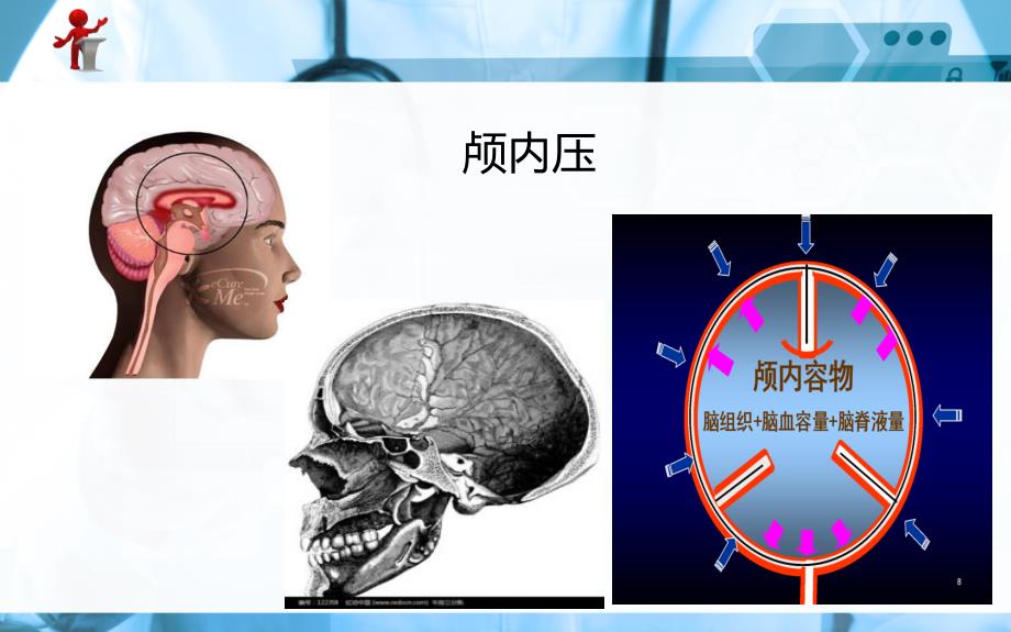 《外科护理》第十章_第一节 颅内压增高病人的护理图文课件_第3页