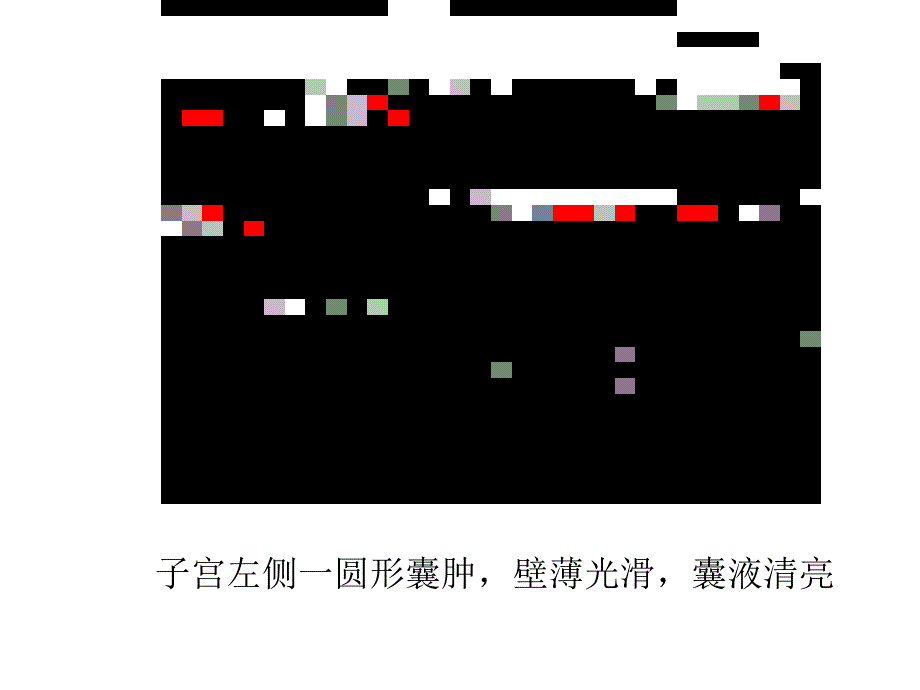 卵巢疾病超声显像鉴别诊断课件_第4页