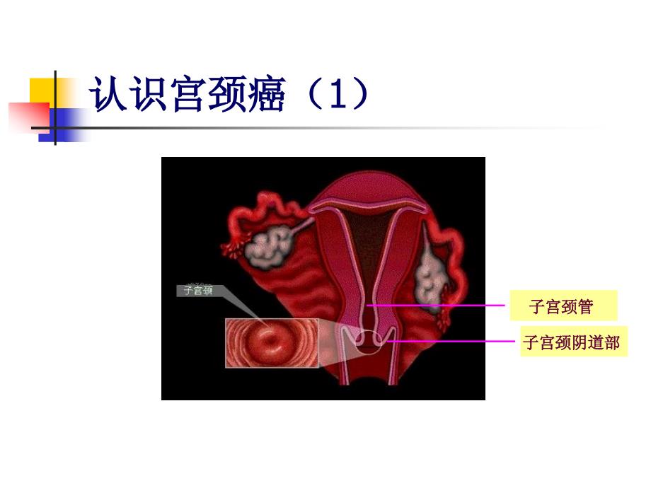 宫颈癌的护理查房课件_第2页