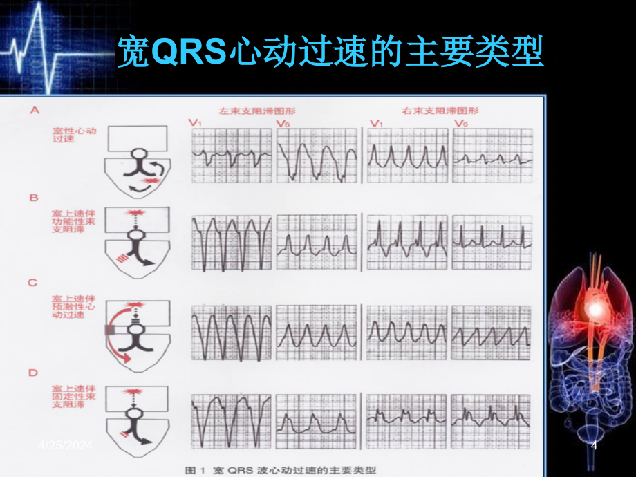 宽qrs波心动过速鉴别诊断新流程课件_第4页