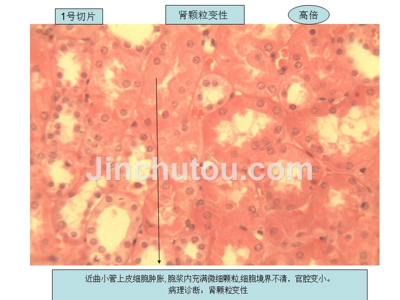 疾病机制精品教学（汕头大学）病理切片总结课件_第2页