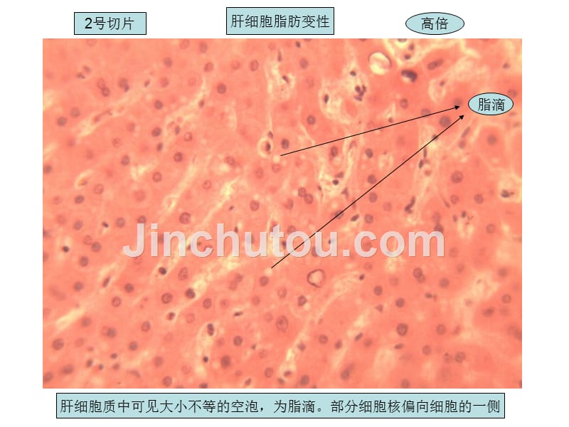 疾病机制精品教学（汕头大学）病理切片总结课件_第4页