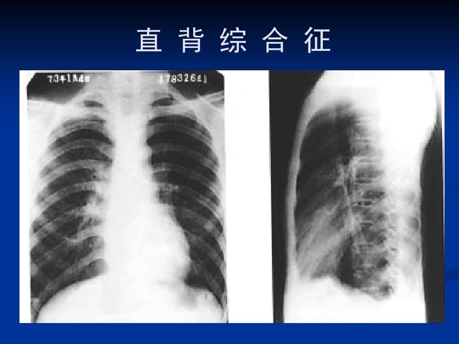 医学影像教学资料_心脏大血管异常的基本影像学征象课件_第5页