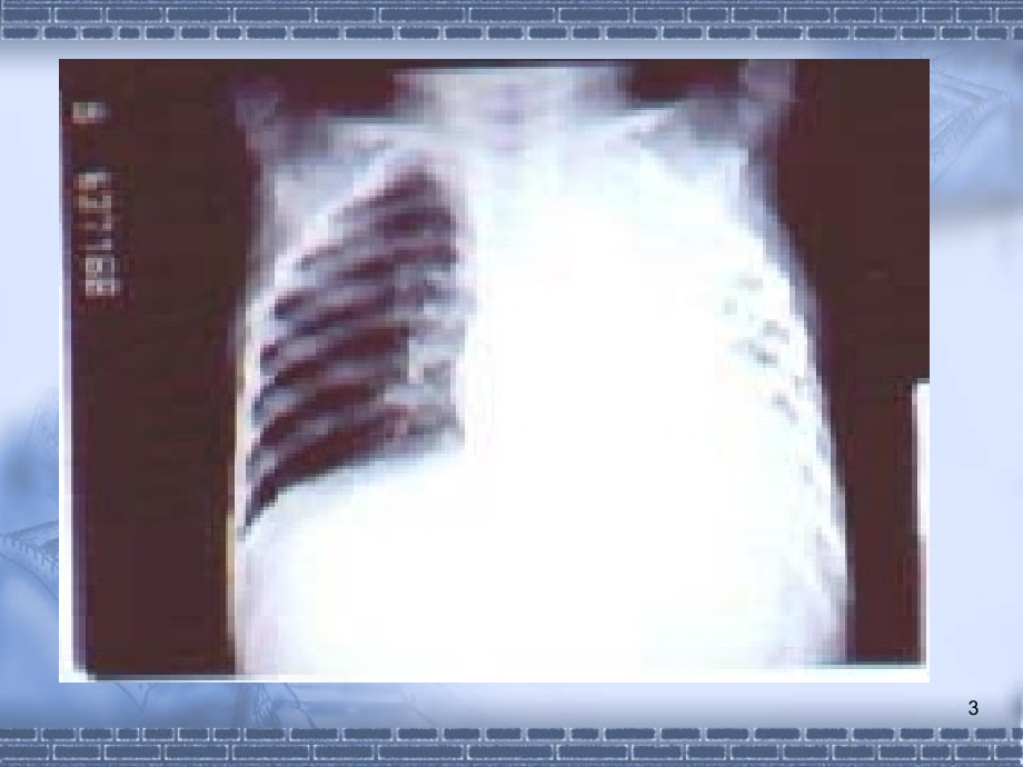 儿童反复呼吸道感染 ppt课件_第3页