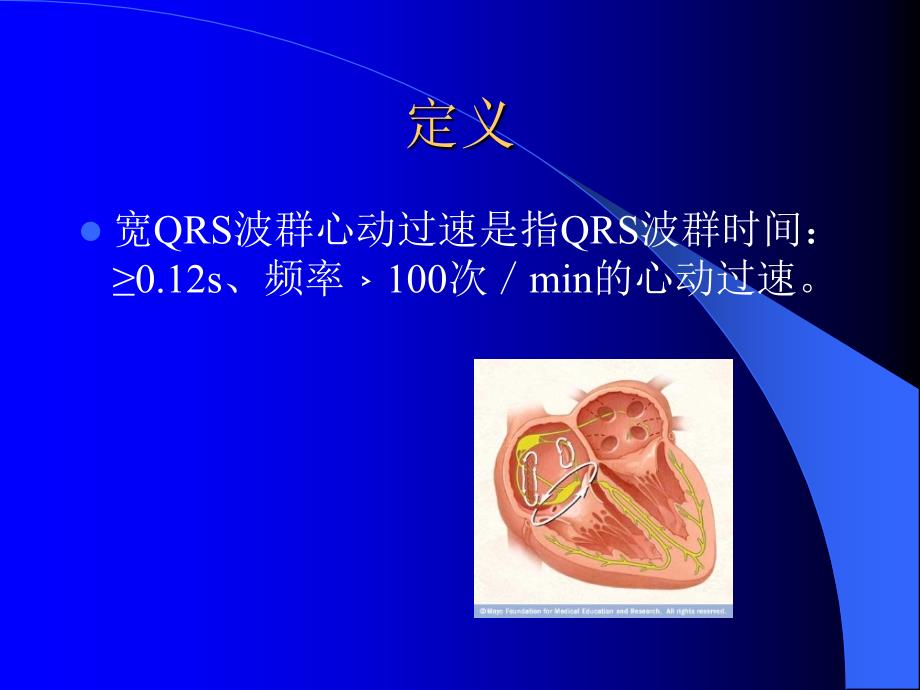 宽qrs波心动过速的课件_第2页