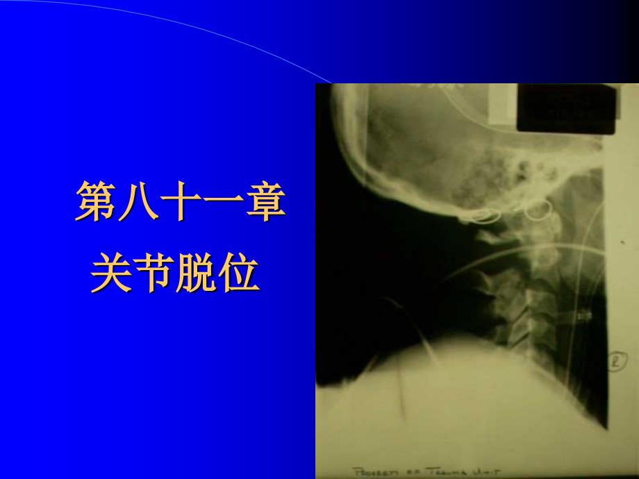 同济外科学课件ppt之关节脱位_第1页