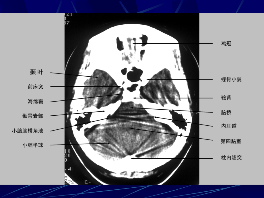 中枢神经系统肿瘤影像学课件_第3页