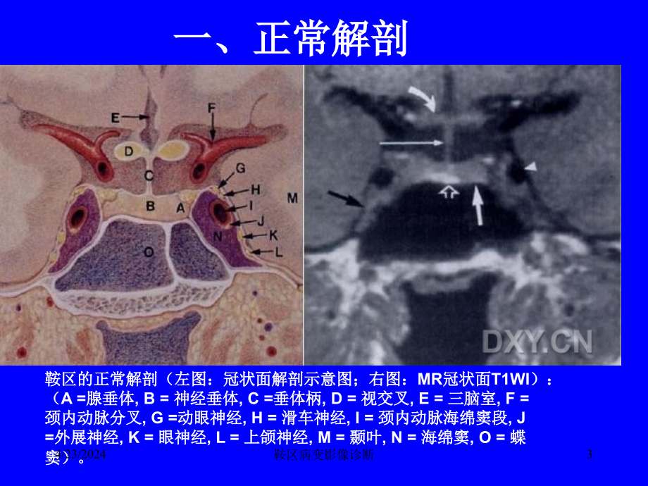 鞍区病变影像诊断ppt课件_第3页