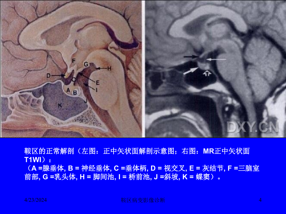 鞍区病变影像诊断ppt课件_第4页