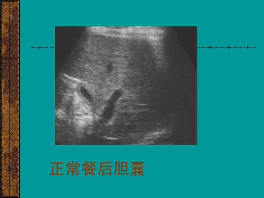 教学胆脾胰（临床）ppt课件_第5页